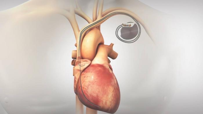 Biomédicos criam espécie de marcapasso para tratar hipertensão - 1