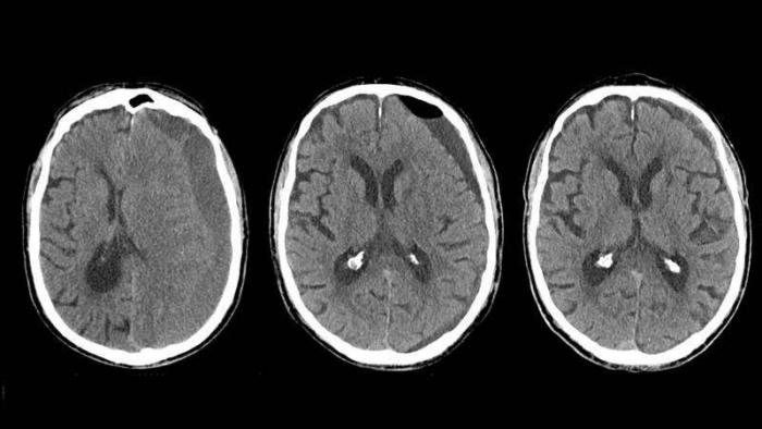 Cientistas criam software de IA que identifica hemorragia cerebral com rapidez - 1