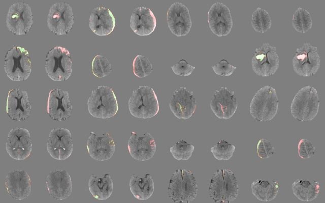 Cientistas criam software de IA que identifica hemorragia cerebral com rapidez - 2