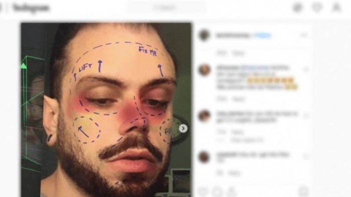 Instagram remove filtros que simulavam marcações de cirurgia plástica; entenda - 1