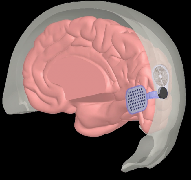 Dispositivo implantado no cérebro pode devolver parte da visão a cegos - 2