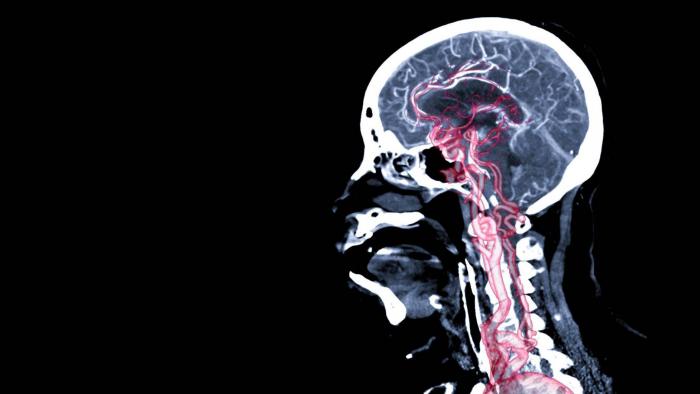 IA consegue prever se você terá aneurismas cerebrais; mas é seguro usá-la? - 1