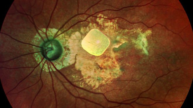 Pra cego ver: implantes, gadgets e até vírus podem devolver parte da visão - 2