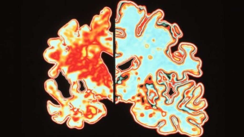 Você encararia? Testes identificam se você tem predisposição para o Alzheimer - 3