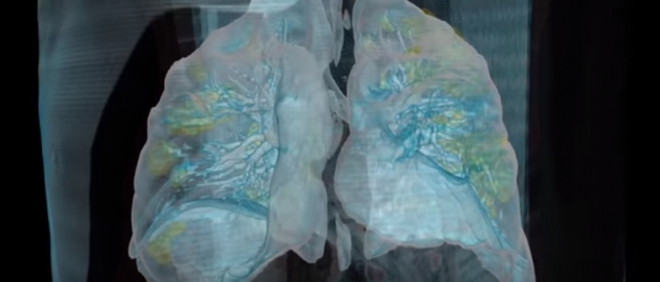 Veja como fica o pulmão de um paciente com sintomas graves de COVID-19 - 2