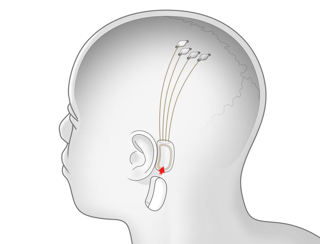 Neuralink | O que é e como funciona o projeto que conecta um chip ao cérebro - 3