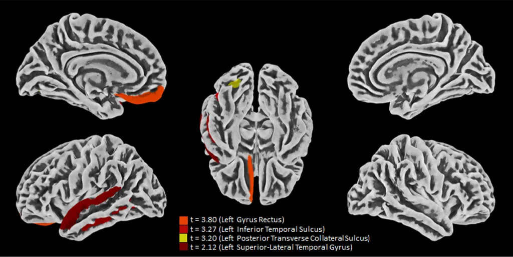 Áreas afetadas pela covid-19 no cérebro dos pacientes: as cores representam atrofia na grossura cortical (Imagem: Crunfli et al./PNAS)