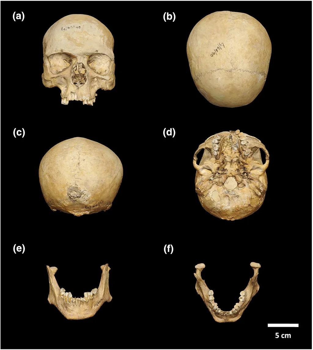 A arcada dentária e crânio do homem polonês medieval indicaram a presença das doenças (Imagem: Matczak et al./International Journal of Osteoarcheology)