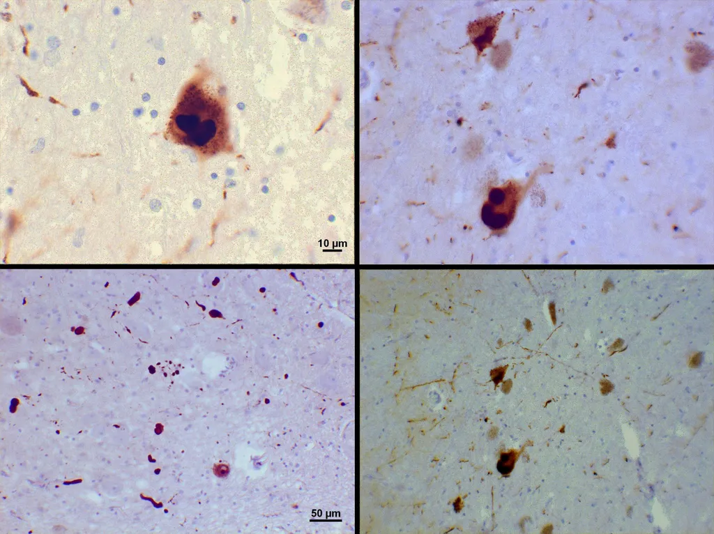 Corpos de Lewy, aglomerados de alfa-sinucleína presentes em pacientes com Parkinson (Imagem: Suraj Rajan/CC-BY-3.0)