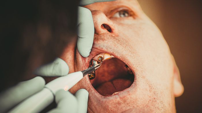 Australiano sofre sangramento no cérebro após extrair dente - 1