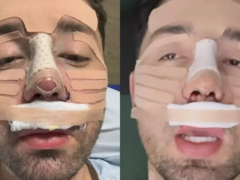 Rico Melquiades faz cirurgia no nariz e mostra resultado - 1